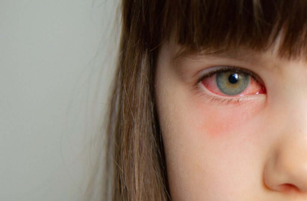 Close-up of a child's irritated eye due to pink eye.