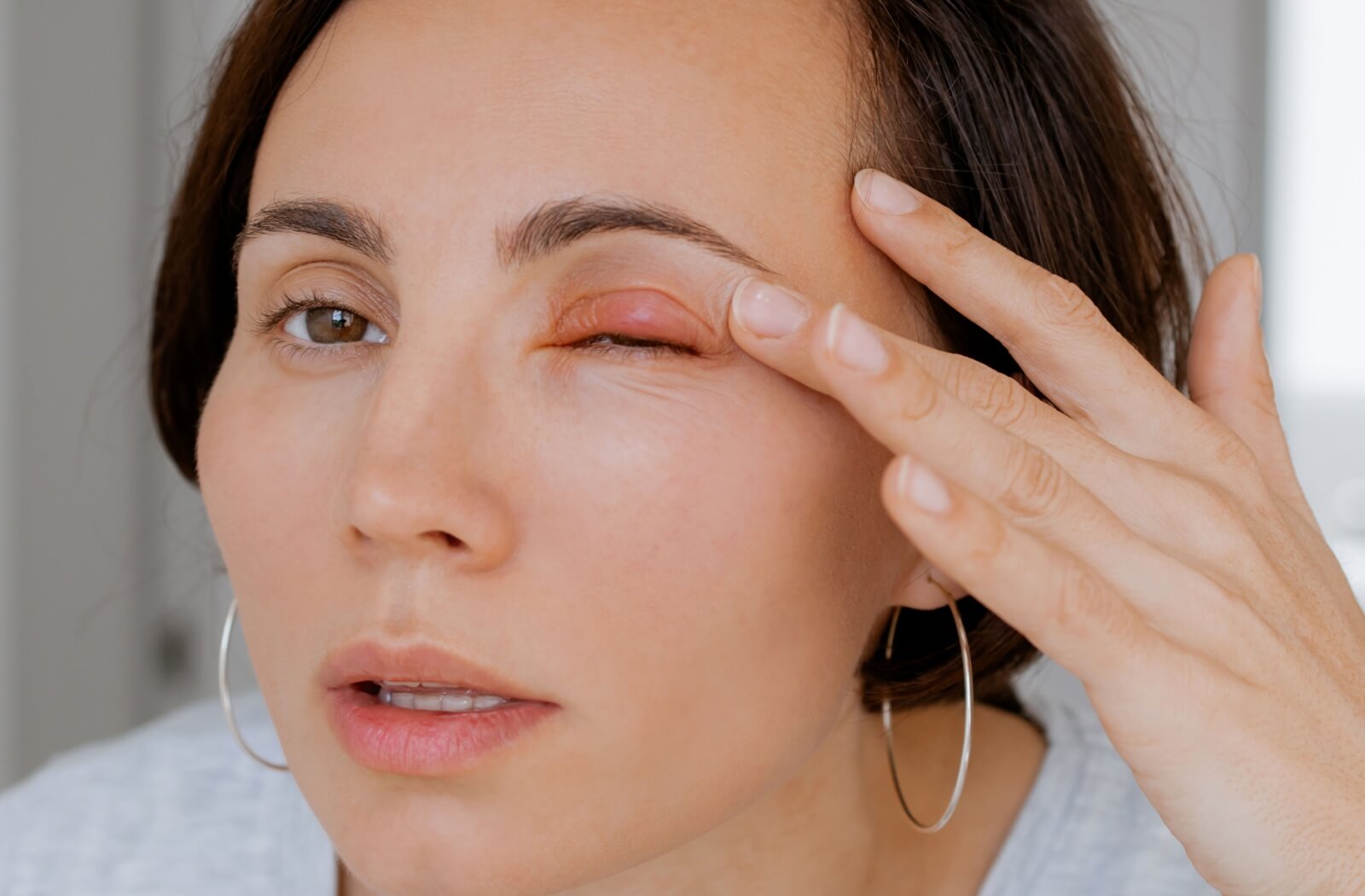 A person inspects a small, red stye on their eyelid.
