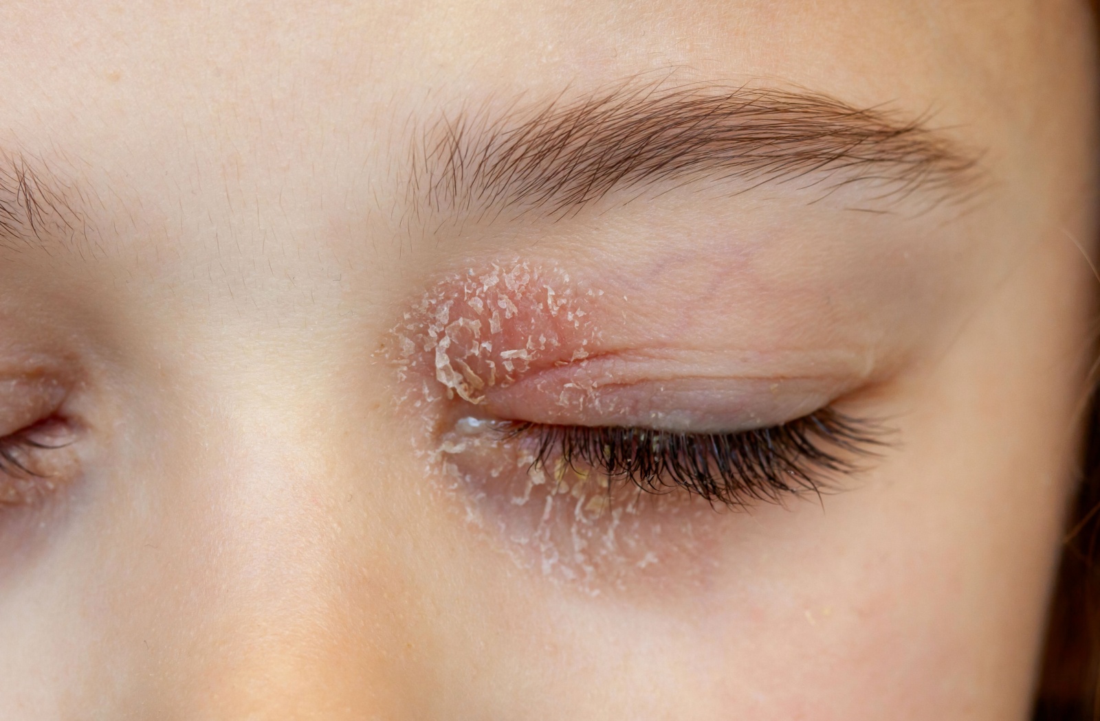 A close-up photo of an eyelid with visible flaking, showing symptoms of blepharitis.