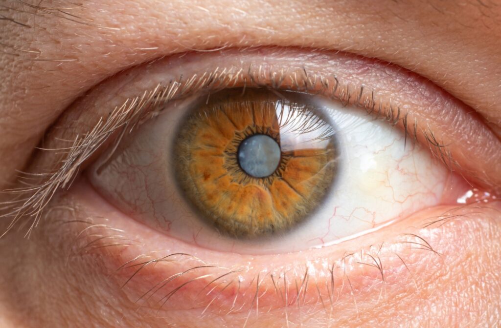 A close-up image of an eye that's developing a cataract.