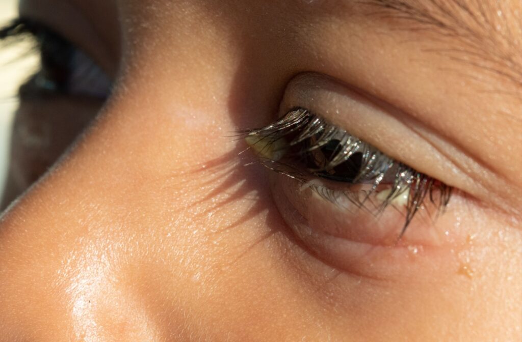 Close-up of an eye with yellow discharge coating eyelashes.