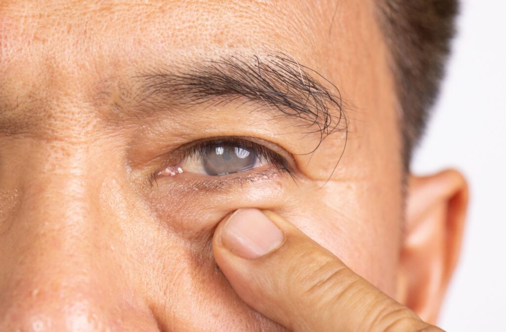 Close-up of someone's eye with a cloudy lens due to cataracts.