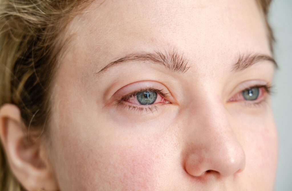 Close-up of a person’s eye showing redness and mild irritation around the eyelid, indicating possible eye infection or allergic reaction.