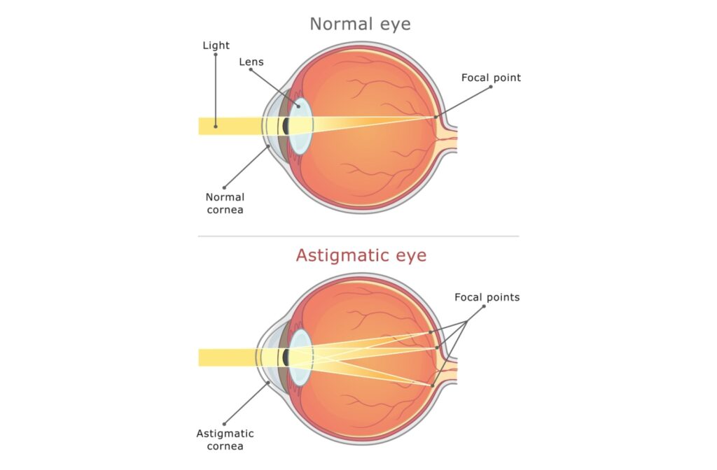 Medical diagram comparing a normal eye with an astigmatic eye, showing differences in cornea shape and focal points of light.