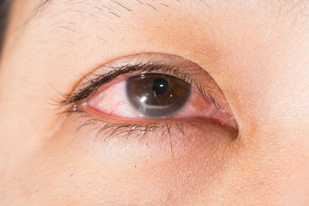 A close-up photograph of a human eye with a brown iris and a red, bloodshot sclera, which may indicate conjunctivitis or eye irritation.