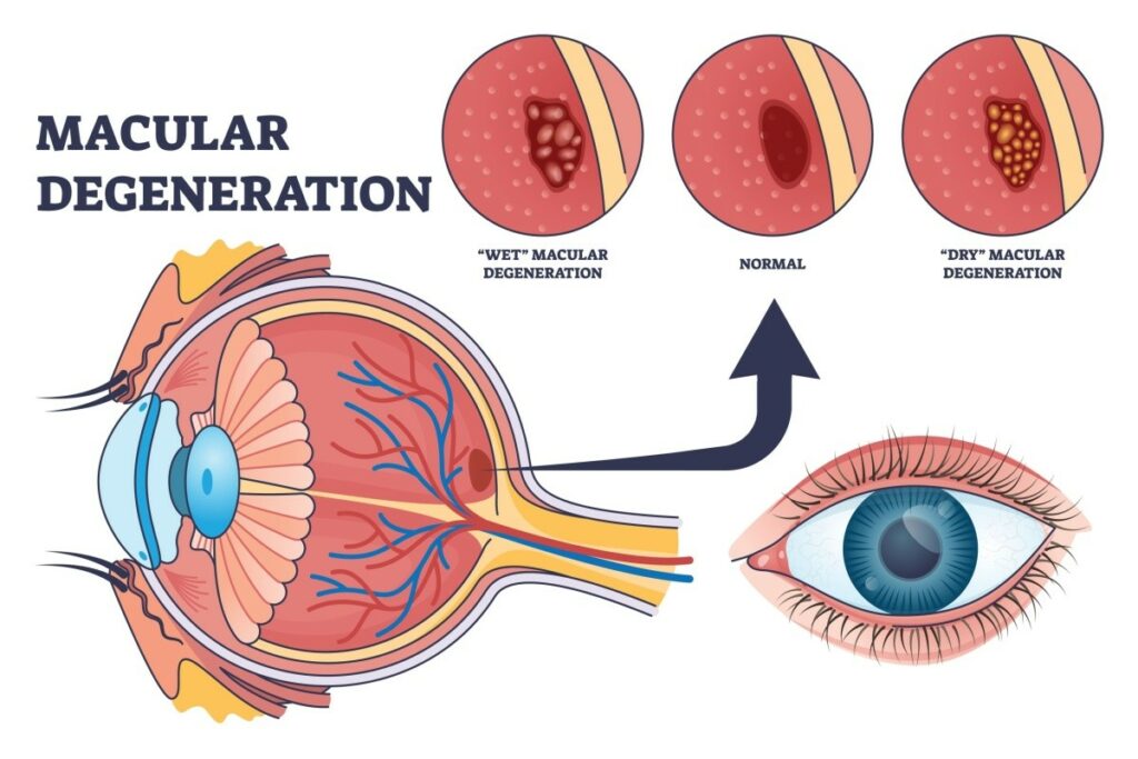 A medical illustration titled MACULAR DEGENERATION showing a cross-section of the human eye and an external view of a blue eye. An arrow points from the macula in the cross-section to three circular close-up views: 'Wet' Macular Degeneration showing lumpy fluid leakage, a Normal macula, and 'Dry' Macular Degeneration showing many small yellow drusen deposits.