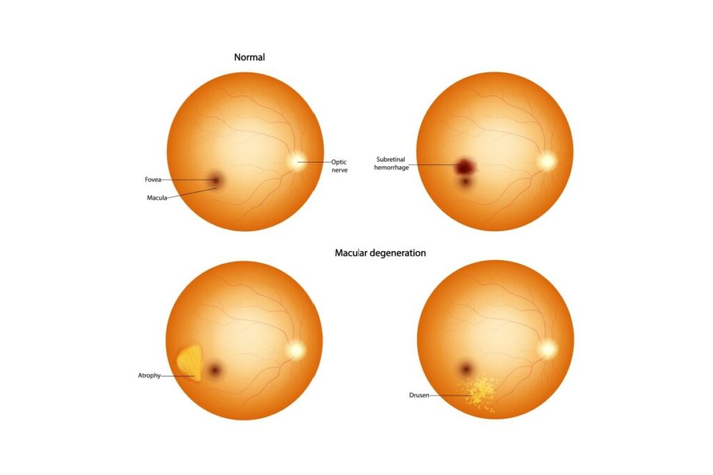 A medical diagram comparing a normal human retina with various signs of macular degeneration. The 'Normal' illustration identifies the optic nerve, fovea, and macula. Three other illustrations show abnormal conditions: subretinal hemorrhage, atrophy, and drusen, which are small yellow deposits associated with macular degeneration.