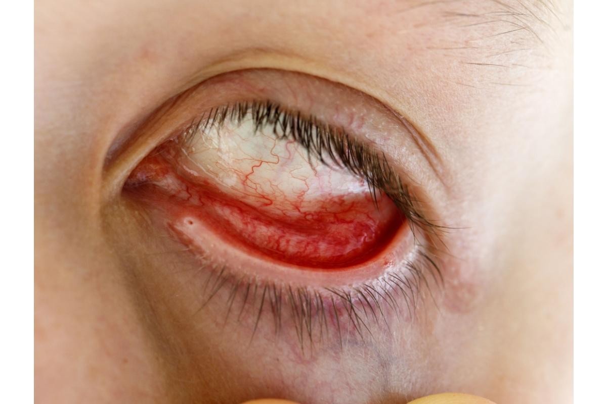 Severe eye inflammation